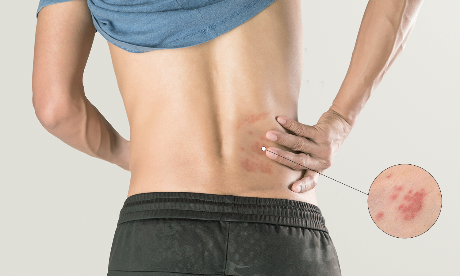 How Gentle Laser Light May Calm Nerve Pain After Shingles
