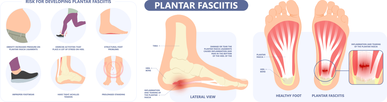 1 Heel Spurs/Plantar Fasciitis