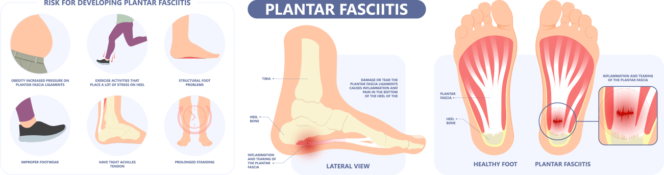 Heel Spurs/Plantar Fasciitis