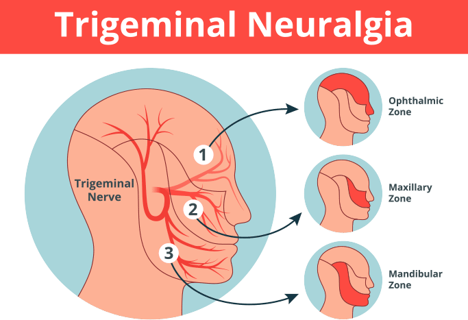 矢量智能对象 Trigeminal Neuralgia