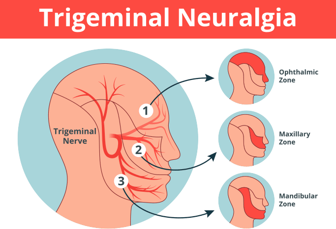 Trigeminal Neuralgia